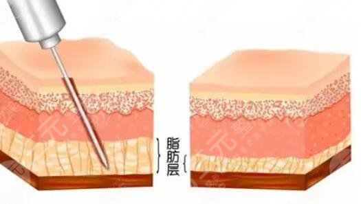 熱瑪吉下頜緣緊致提升