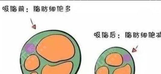 手臂吸脂
