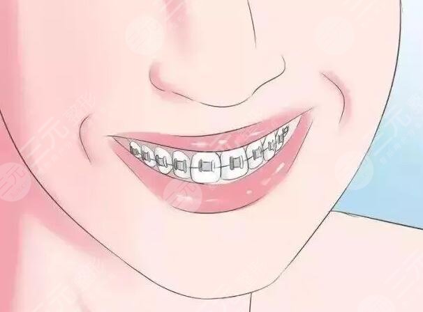 正畸期間如何做口腔護(hù)理?