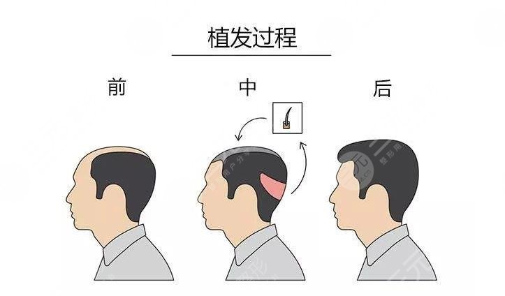 植發(fā)項目相關(guān)科普介紹之M型植發(fā)手術(shù)
