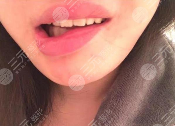 女子整容失敗嘴巴歪，花一年多時(shí)間緩解！整形醫(yī)院只退3.5萬(wàn)手術(shù)費(fèi)！
