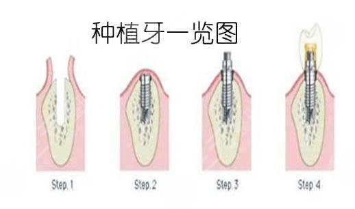 種植牙的過(guò)程步驟有幾個(gè)？過(guò)程需要多長(zhǎng)時(shí)間？牙齒種植流程一文解！