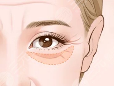 淡化眼部干細(xì)紋的妙招有哪些?什么手術(shù)可以淡化眼部細(xì)紋?