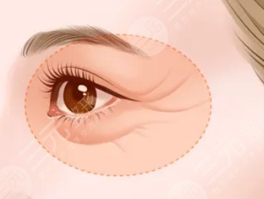 有什么手術(shù)方式可以淡化眼部細(xì)紋?