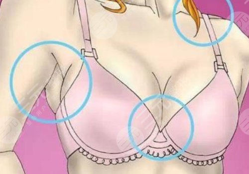 隆胸手術(shù)要多久后才能過正常生活?