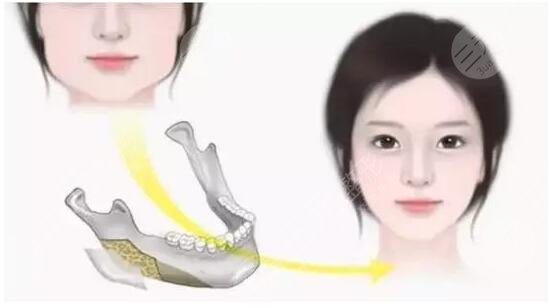 #術(shù)前功課#磨骨瘦臉手術(shù)多少錢？