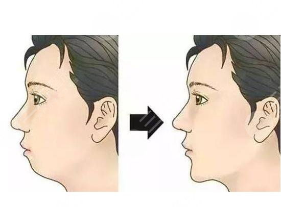 墊下巴多久消腫？怎樣加快消腫？