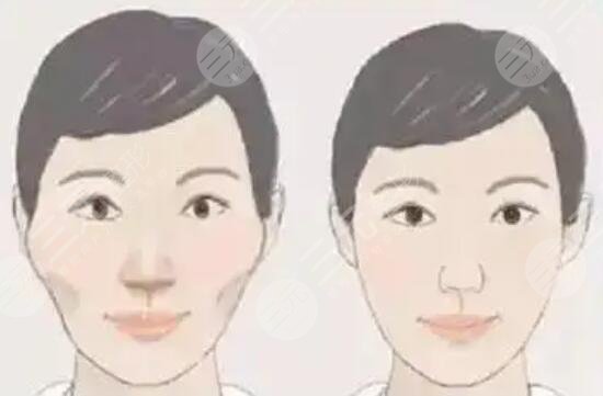 顴骨整形