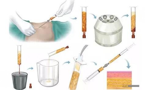 北京悅?cè)会t(yī)院李京霖吸脂的果好嗎？