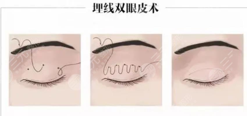 廣州南方醫(yī)院雙眼皮埋線案例