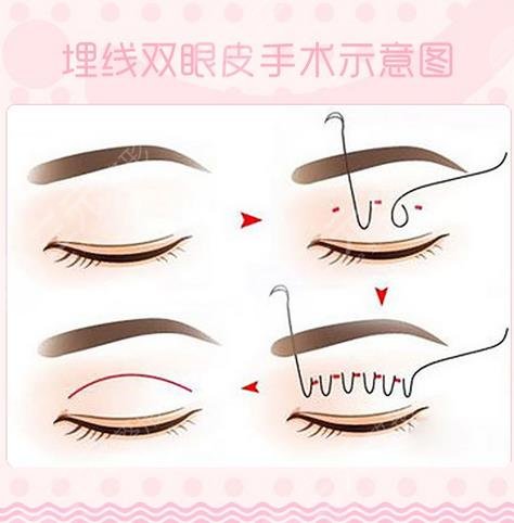 廣州南方醫(yī)院雙眼皮埋線案例