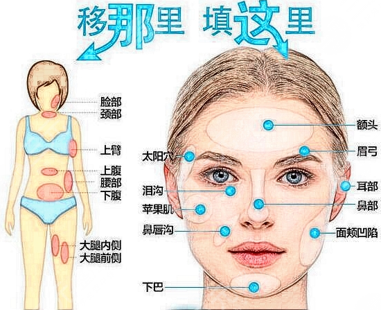 脂肪填充臉部有什么副作用？術(shù)后可能存在的風(fēng)險(xiǎn)有哪些？