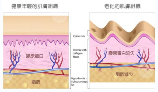 眼部皺紋