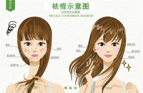 彩光祛痘的價格