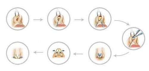 鼻翼缺損矯正手術(shù)會留疤嗎？