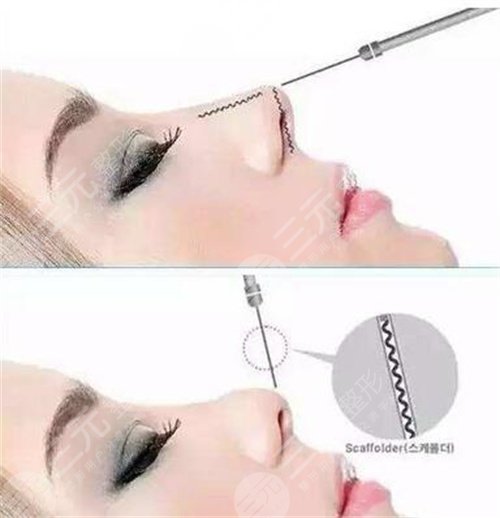 鼻翼缺損矯正手術(shù)適應(yīng)的人群