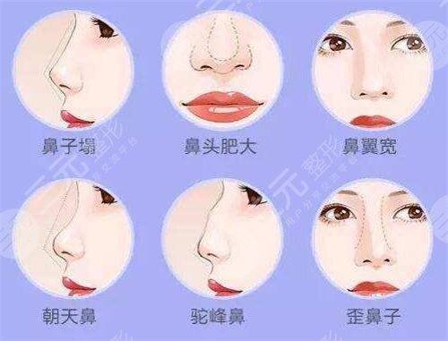 鼻翼缺損矯正手術(shù)適應(yīng)的人群