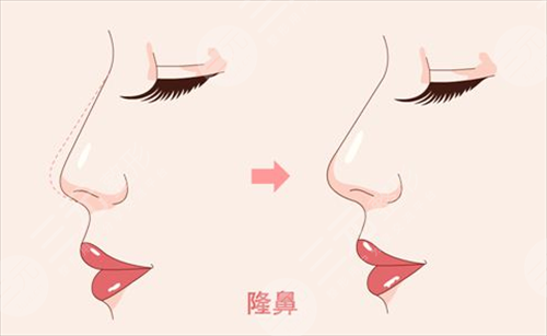 人工骨隆鼻吸收率是多少?手術(shù)前后需要注意的事項(xiàng)