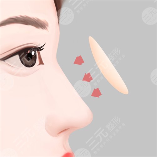 【須知】自體軟骨隆鼻缺點是什么？你能接受嗎？注意事項有哪些？