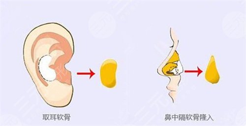 自體軟骨隆鼻注意事項