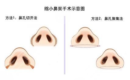 骨膜下隆鼻整形手術(shù)怎么做的？哪種情況適合做？