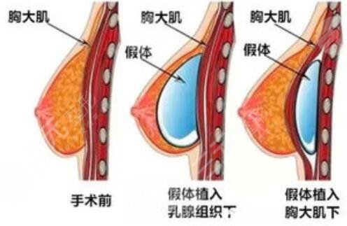 副乳手術(shù)需要多少錢？副乳竟然分“真假”