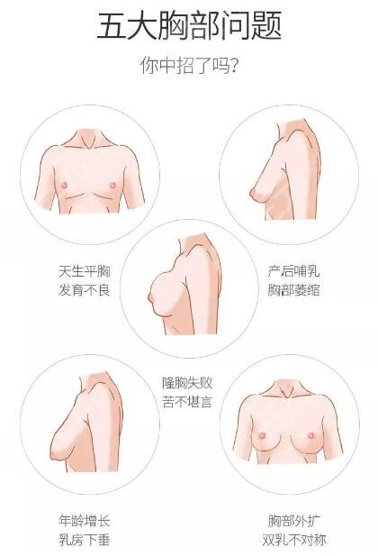 副乳手術(shù)需要多少錢？副乳竟然分“真假”