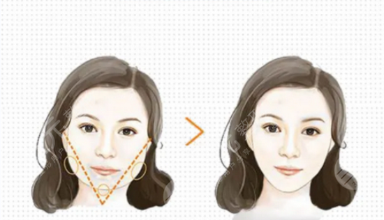 注射瘦臉注射后幾天起？你所關(guān)注的一切有問必答！