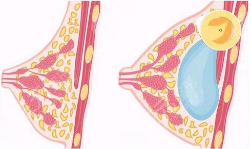 失敗隆胸修復(fù)的難易程度，選擇醫(yī)生小竅門必看！