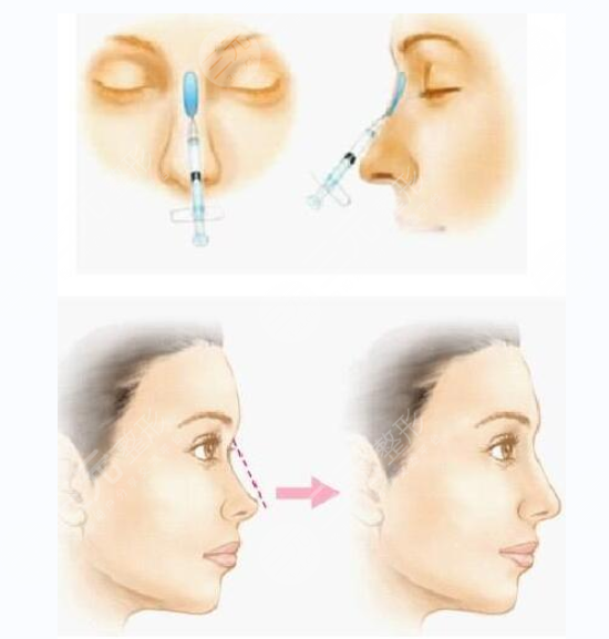 玻尿酸隆鼻到底能保持多久