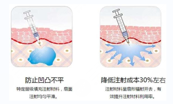 打玻尿酸注意事項