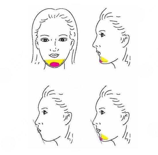 下巴打玻尿酸能保持多久