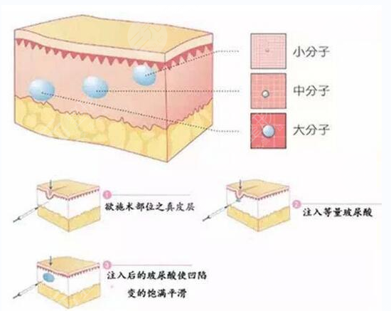 玻尿酸填淚溝經(jīng)驗(yàn)