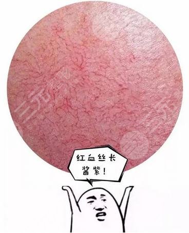 臉上紅血絲是身體出了問題嗎