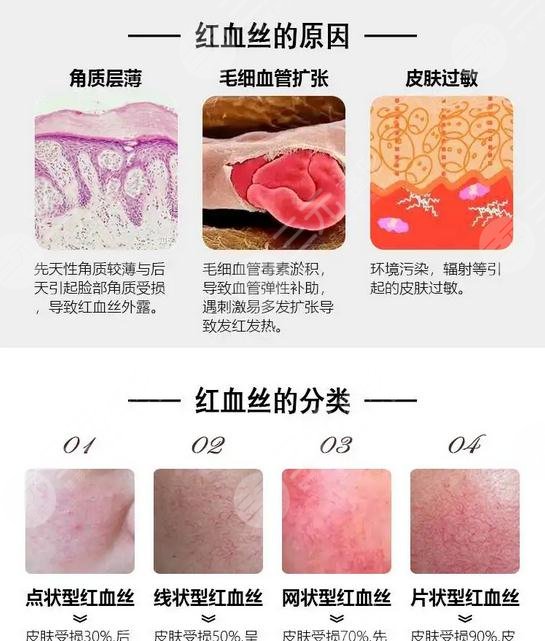 紅血絲應(yīng)該怎樣預防