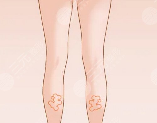 大腿肉注射瘦腿能打嗎