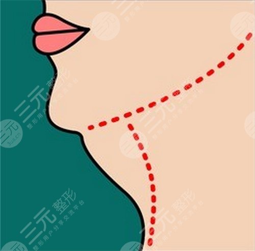 光纖溶脂瘦臉恢復(fù)過(guò)程圖