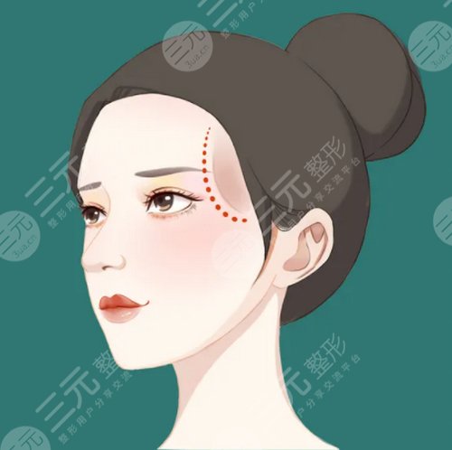 酒窩成形術(shù)前需要注意什么