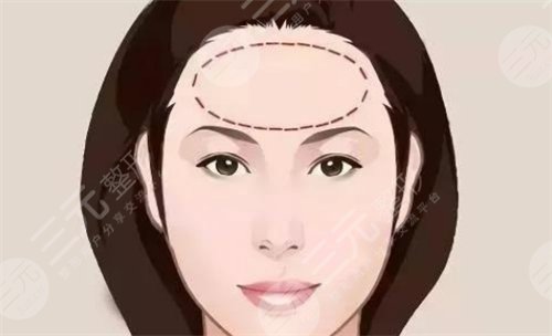 額頭填充術(shù)方法有哪些