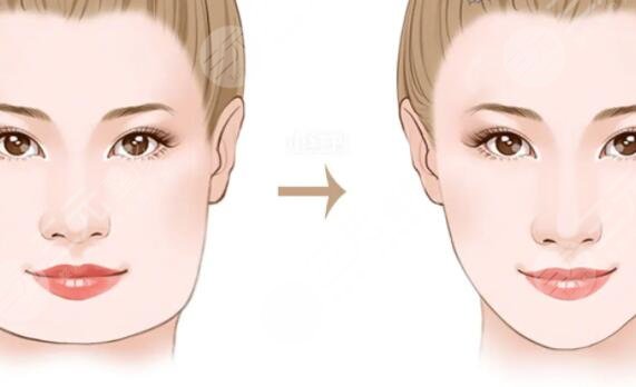 磨骨手術(shù)對比照片真實果查看：術(shù)后妥妥鵝蛋臉！陽光總在風(fēng)雨后~
