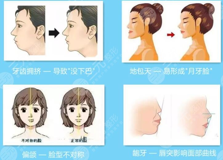 磨骨手術(shù)對比照片