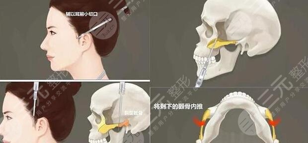 磨骨手術(shù)術(shù)前注意事項