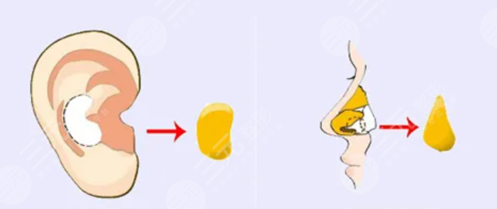 鼻修復(fù)