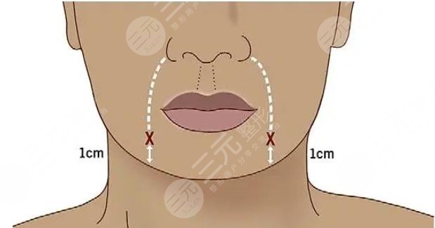 嘴唇外翻厚嘴唇緩解準(zhǔn)備工作有哪些?