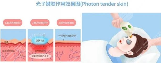 光子嫩膚原理