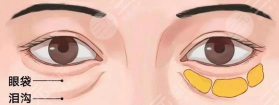 超聲波去眼袋