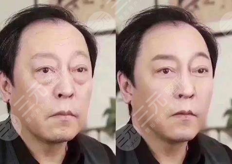 超聲波去眼袋