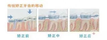 傳統(tǒng)牙齒矯正