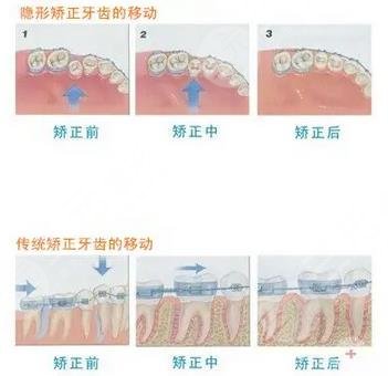 牙齒矯正步驟