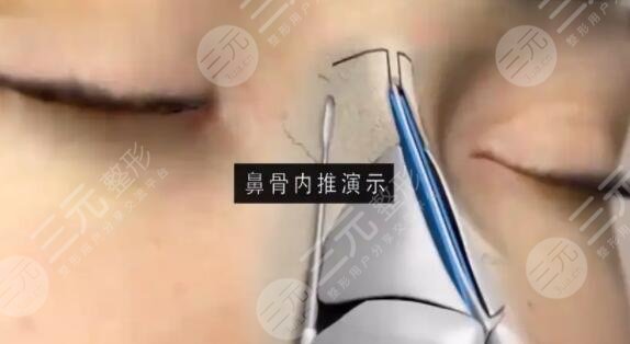 鼻骨內(nèi)推前后果分享，一個小小的改變就能讓顏值直接飆升好幾個level~